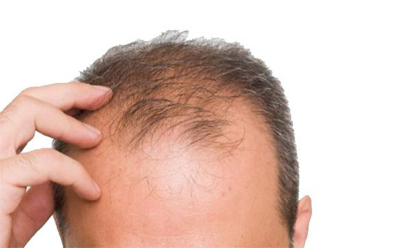 erkek saclandırma sistemleri